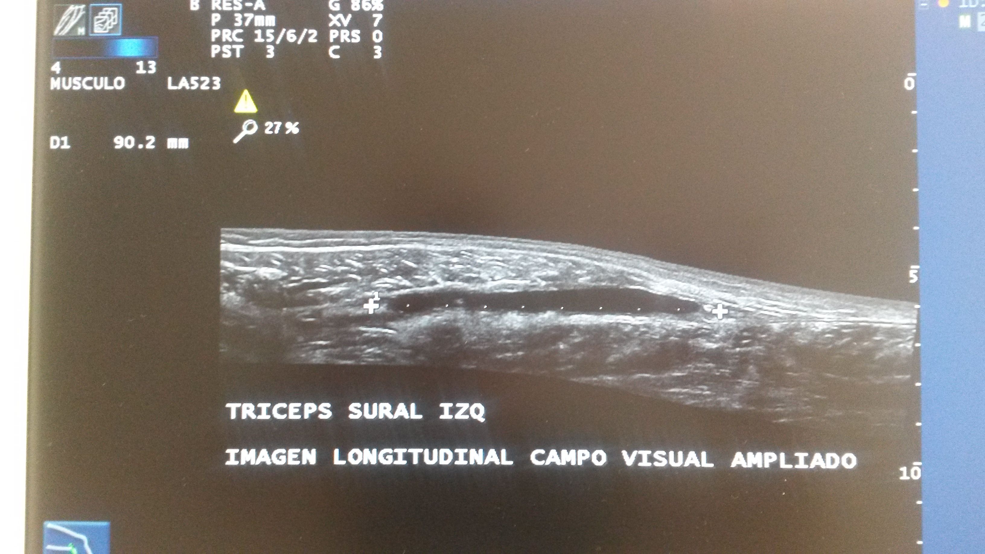 Imagen ecográfica de corte longitudinal del gemelo interno y sóleo. donde se aprecia el hematoma de 9 cm de longitud